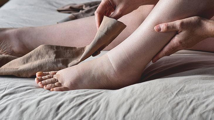 Bacaklarım neden kalın? Önce şişiyor, sonra ağırlaşıyor: ‘Erken müdahale kritik’